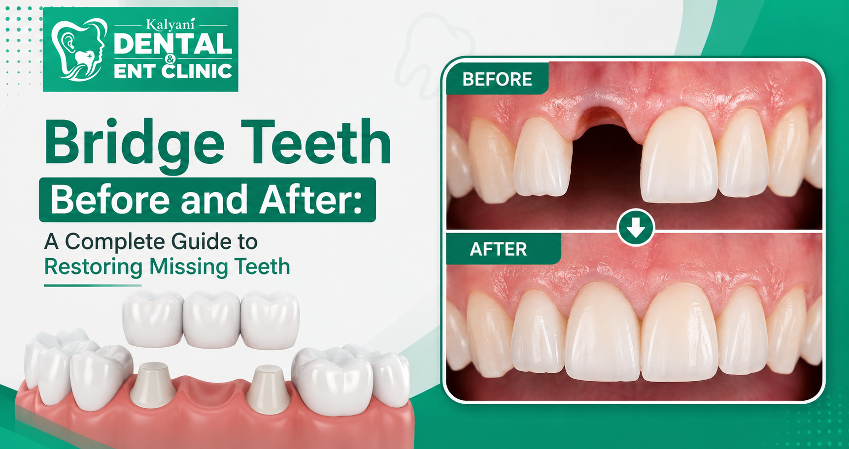 Bridge Teeth Before and After | Smile Transformation Guide