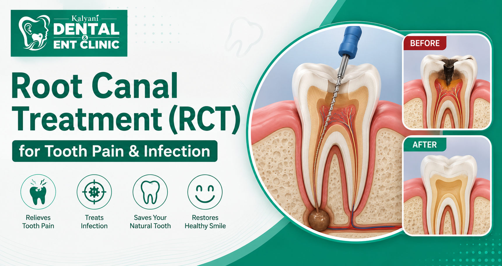 Root Canal Treatment for Tooth Pain & Infection | Kalyani Dental