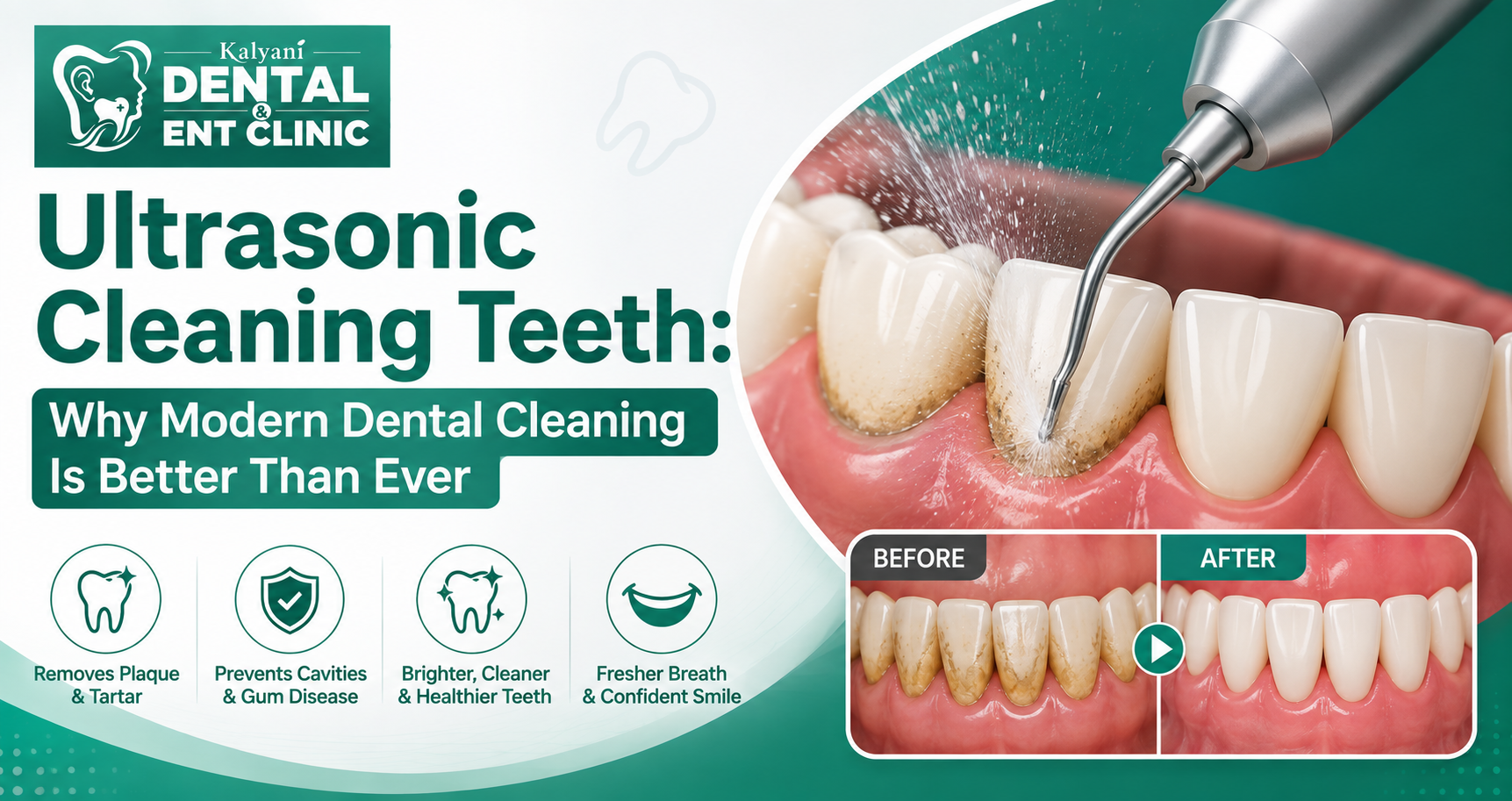 Ultrasonic Cleaning Teeth: Benefits, Procedure & Safety Guide